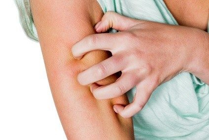 Psoriasis kann den Berufsweg einschneidend verändern. Foto: Gina Sanders - Fotolia.com